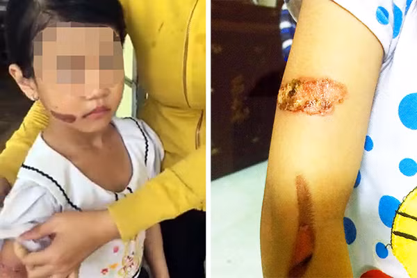 Các vết thương của cháu T. nghi bị bạo hành.