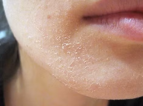 Da bị viêm, hư tổn do tác động không đúng cách từ bên ngoài.