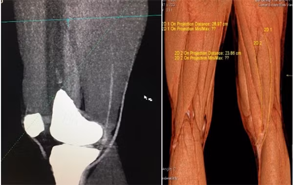 Hình ảnh dựng hình 3D trên CLVT đo kích thước gân trước mổ. Hình ảnh dựng hình 3D trên CLVT đo kích thước gân trước mổ.