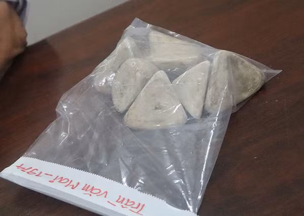 Các viên sỏi bàng quang kích thước lớn.