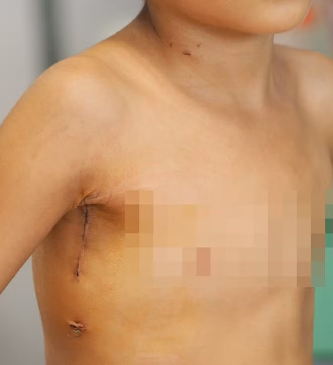 Phẫu thuật mổ tim bằng kỹ thuật mới mang lại hiệu thẩm mỹ quả cao, bệnh nhân ít đau và hồi phục nhanh hơn.