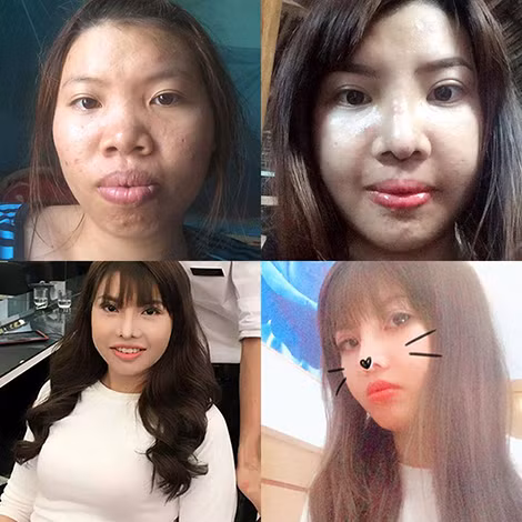 Hotgirl dao kéo đổi đời từ Thị Nở thành thiên nga, câu ngàn like.
