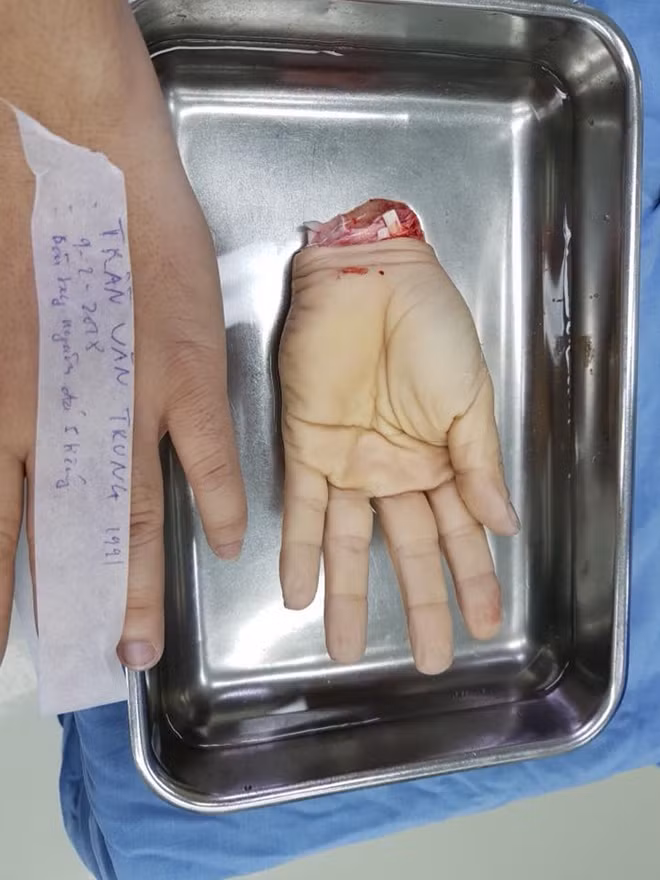Cận cảnh cánh tay đứt lìa của bệnh nhân Trần Văn T. được ghép nối thành công và có phản xạ để tiến đến tập phục hồi chức năng.