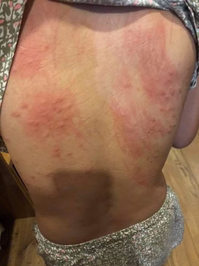 Nhiều du khách và trẻ em ở Đà Nẵng bị nổi mẫn đỏ, ngứa sau khi tắm biển.