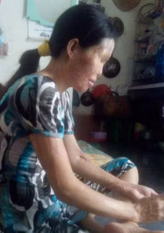 10 năm qua, Thủy phải sống chui lủi, trốn tránh tất cả bạn bè chỉ vì khuôn mặt biến dạng của mình.