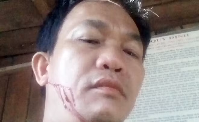 Vết rách trên mặt của kiểm lâm viên Nguyễn Thà sau khi bị lâm tặc tấn công.