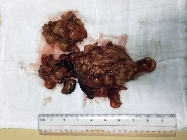 Khối u lấy khỏi trung thất cho bệnh nhân. Khối u lấy khỏi trung thất cho bệnh nhân.