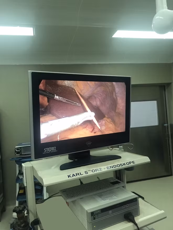 Hình ảnh cây tăm tre nhọn đâm xuyên thủng dạ dày do bệnh nhân nuốt phải khi đang nằm võng, ngậm tăm xỉa răng.
