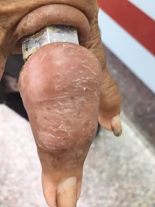 Ngón tay cụ Trần Thị Quánh có nguy cơ bị hoại tử do "chiếc nhẫn" bulong sắt chèn ép.
