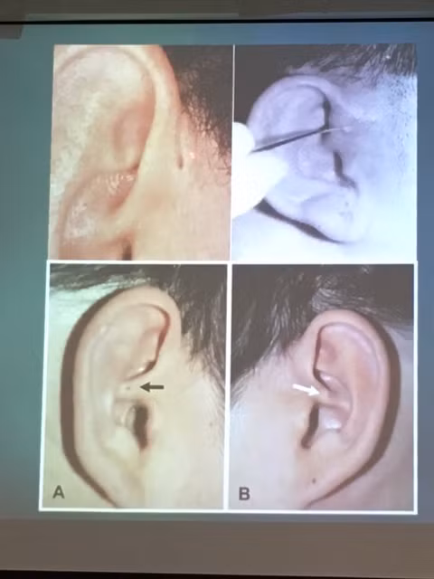 Các vị trí thường gặp trên vùng tai của bệnh nhân có dị tật bẩm sinh "lỗ rò luân nhĩ".