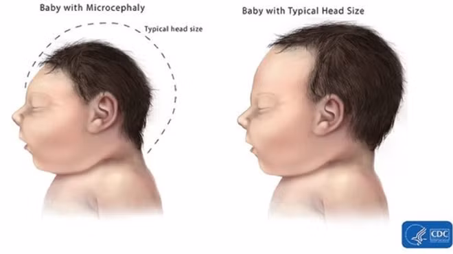 Nhiều thông tin mới được công bố qua giám sát các ca bệnh nhiễm Zika cho thấy, di chứng trên trẻ sinh ra từ bà mẹ nhiễm vi rút Zika cần được cảnh giác cao độ.