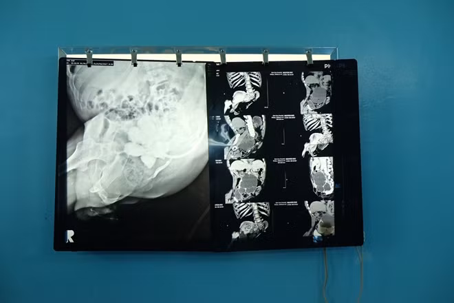 Hình chụp CT-Scan vùng bụng-chậu của bệnh nhân Nguyễn Đức.