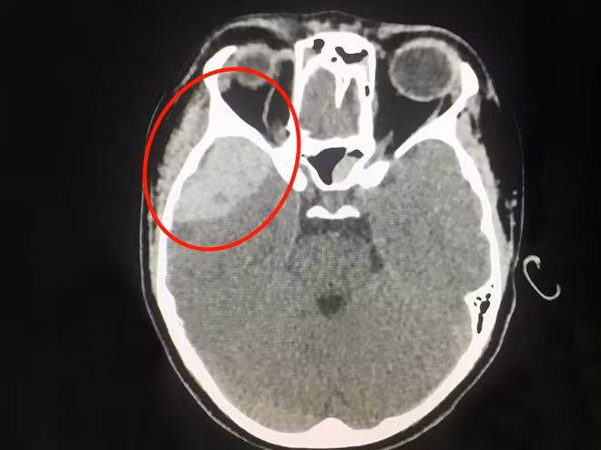Hình ảnh vùng sọ não bị tổn thương qua chụp CT- Scan.