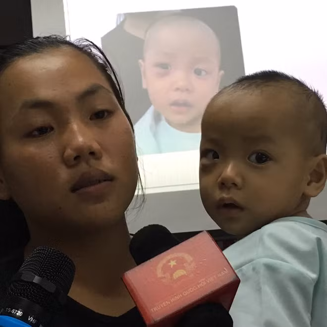 Mắt bé trở lại bình thường sau 6 ngày được phẫu thuật dẫn lưu ổ mủ ra ngoài thành công.