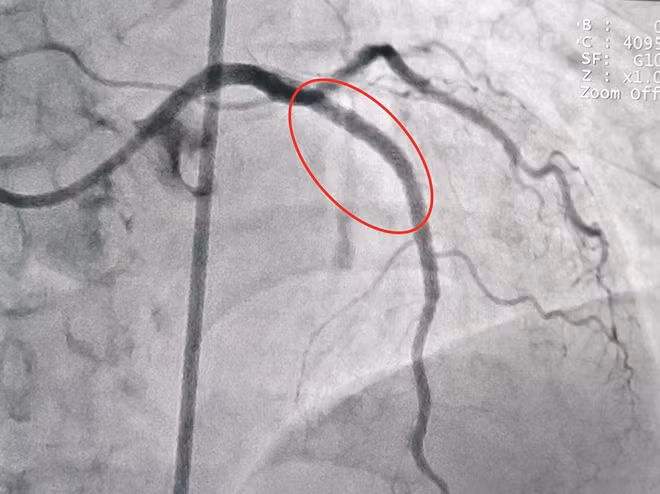 Hình ảnh mạch máu bệnh nhân sau khi được can thiệp đặt stent thông mạch vành.