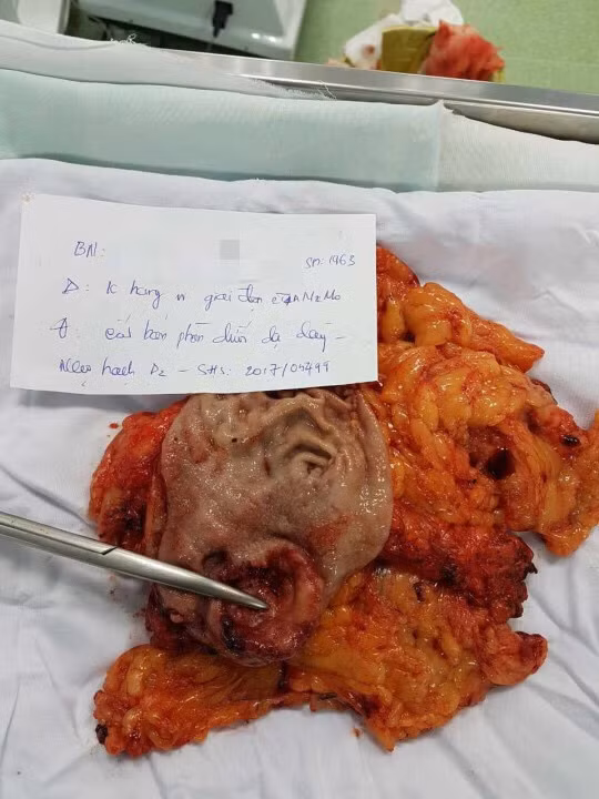 Hình ảnh khối u và khối mỡ chứa các hạch ung thư đã được lấy ra từ cơ thể BN.