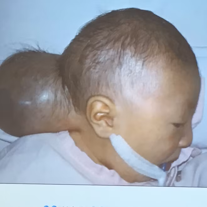 Hình bé gái trước khi được phẫu thuật bóc tách khối thoát vị.