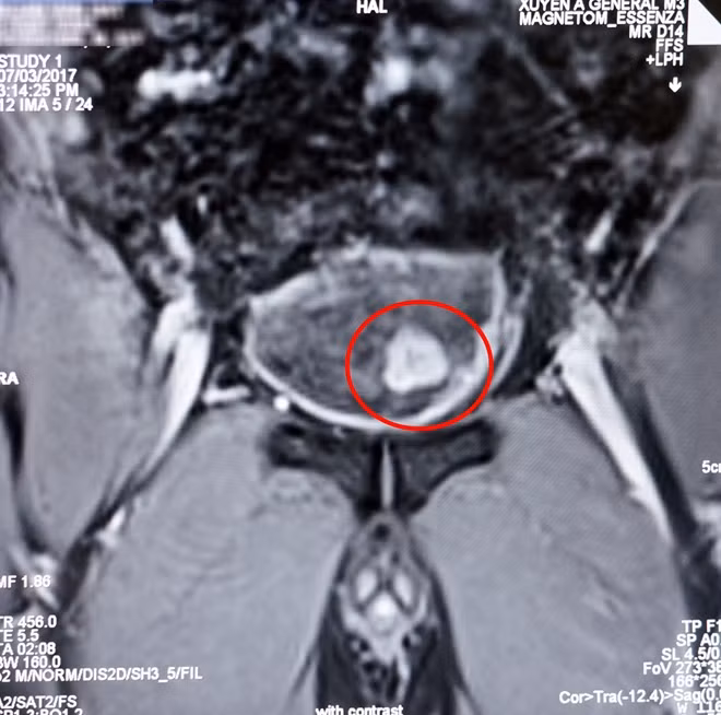 Hình ảnh khối u bàng quang xâm lấn qua kết quả chụp Mri của bệnh nhân.