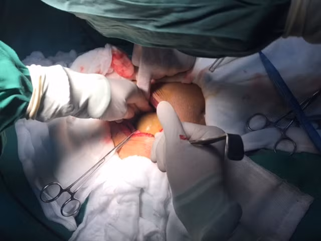 Các BS đang phẫu thuật lấy viên sỏi bàng quang "khủng" ra khỏi người bệnh nhân B. (ảnh do các BS cung cấp)
