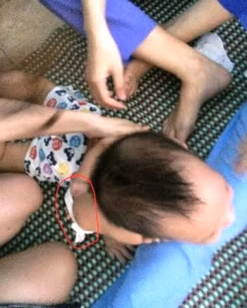 Cháu L bị các bảo mẫu trói quặt tay ra phía sau (ảnh trang cá nhân của mẹ cháu cung cấp). Cháu L bị các bảo mẫu trói quặt tay ra phía sau (ảnh trang cá nhân của mẹ cháu cung cấp).