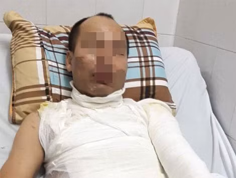 Anh Bùi Đức Hậu bị bỏng rất nặng.