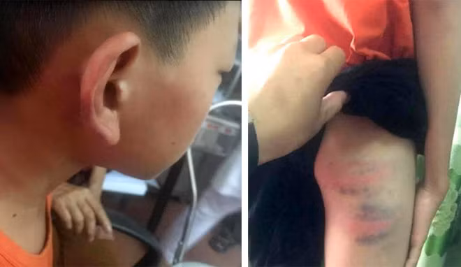 Cháu T. và những vết thương trên mặt, tai và chân.