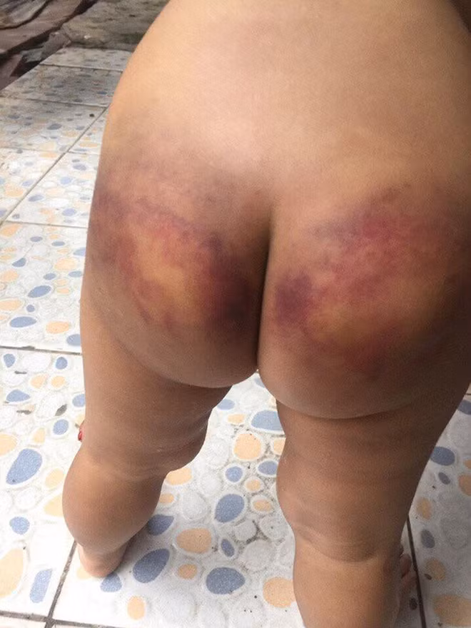 Vết bầm lớn và thương tích trên người cháu bé