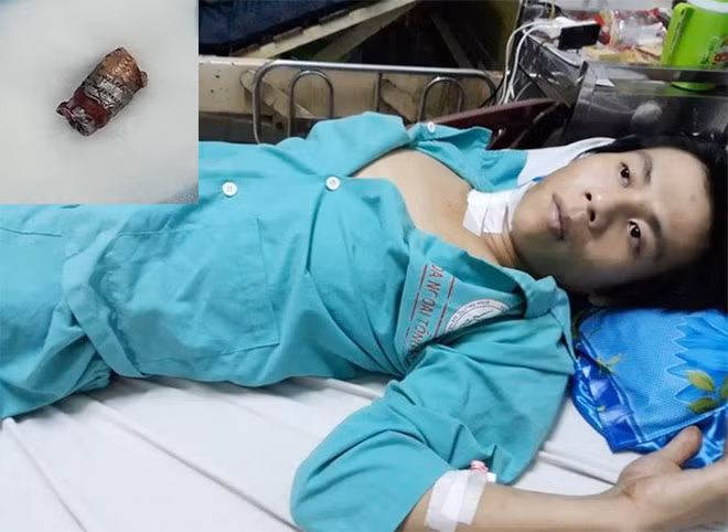 Viên đạn được lấy ra từ cổ anh Hồ Sỹ Hậu.