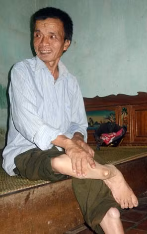 Anh Hà Hữu Đát với đôi chân bị tật.
