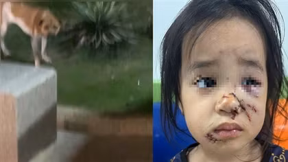 Bé gái 5 tuổi khi chơi ở công viên bị chó cắn gây thương tích nặng