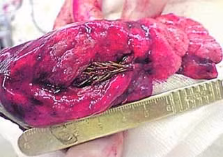 Cây linh sam cao 5 cm trong phổi của Sidorkin. Ảnh: Daily Mail.